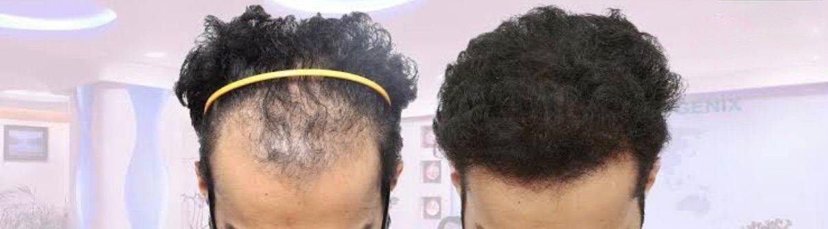 Hair treatments